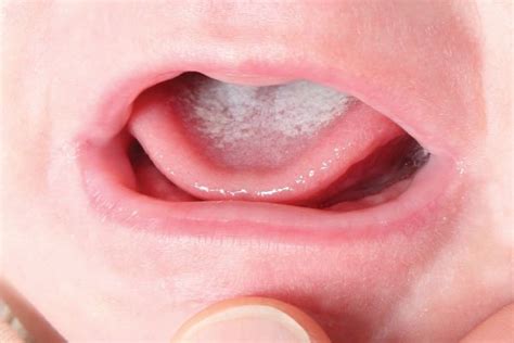 Will oral thrush go away by itself?