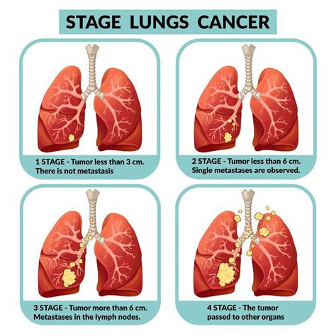 Will oxygen help stage 4 lung cancer?