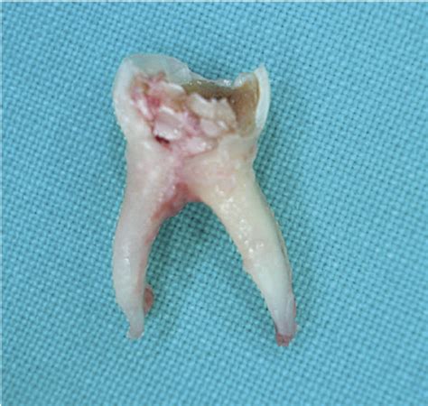 Will pulling a tooth stop infection?