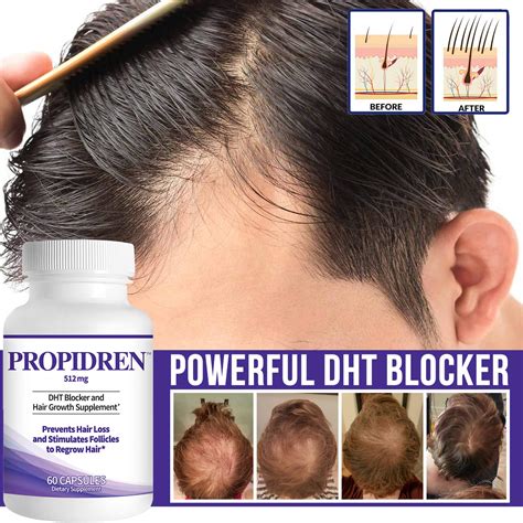 Will reducing DHT regrow hair?