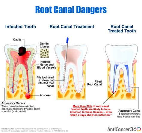 Will root canal pain eventually go away?