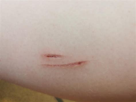 Will scabs leave a scar?