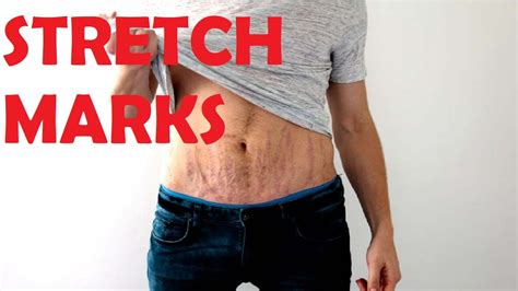 Will stretch marks go away if I lose weight?