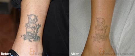 Will tattoo removal ever be painless?