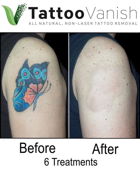Will there ever be painless tattoo removal?