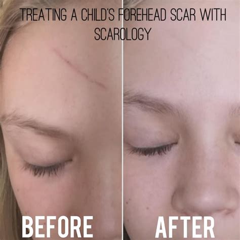 Will toddler scar fade?