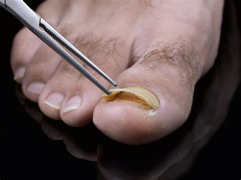 Will toenail fall off naturally?