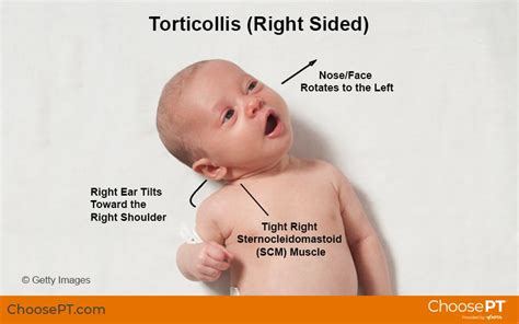 Will torticollis go away?