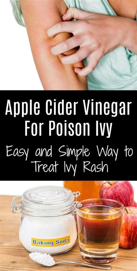Will vinegar stop poison ivy?