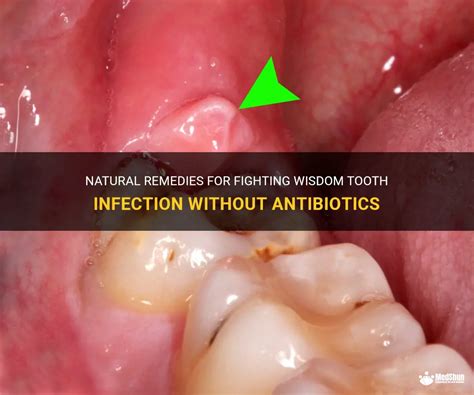 Will wisdom tooth infection go away with antibiotics?